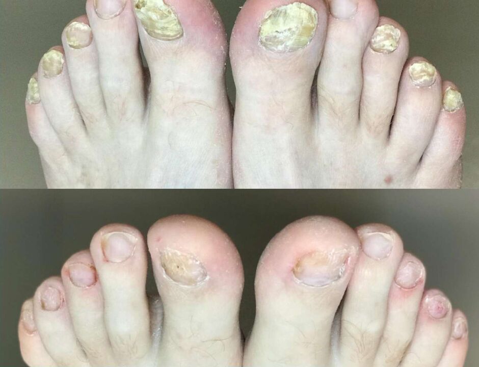 Before and after treatment, the Promisil Cream fungus