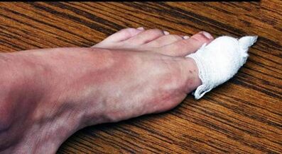 Compress to treat the fungus in the thumb