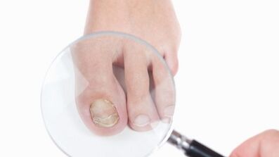 How to treat a fungus in the thumb