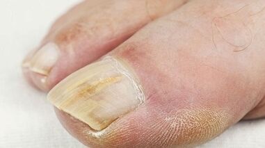 The reasons for the appearance of the fungus in the thumb