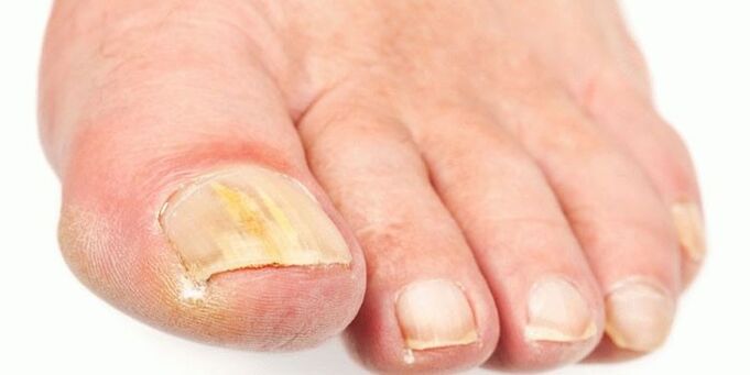 Effective nail fungus products