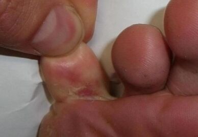 cracked toe due to fungal infection