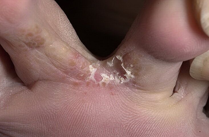 Cracked skin between the toes is a symptom of intertriginous fungus