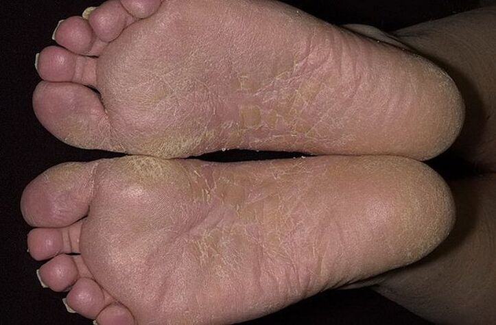 Dry, flaky skin on the feet is a sign of scaly ringworm