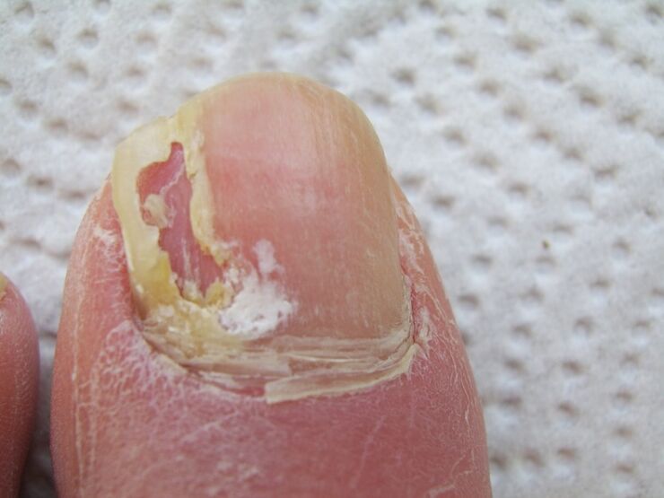 In onychomycosis, deformation of the nail plate occurs