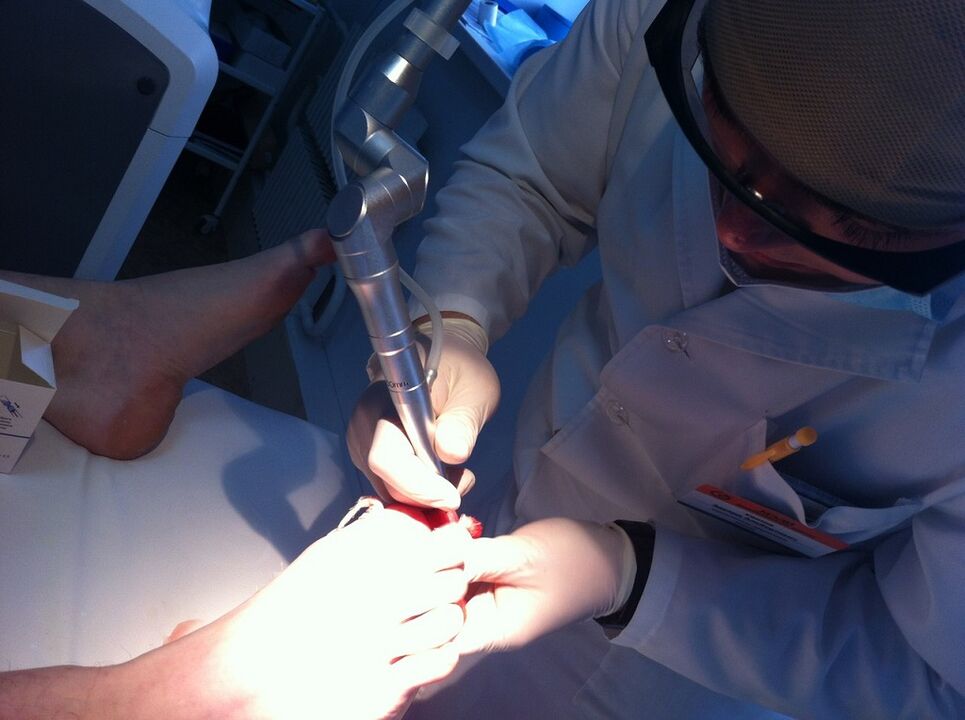 LASER TREATMENT OF MICOSIS